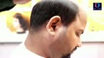  Hair Patch For Men | Hair Wig For Men | Bald Patch on Head 